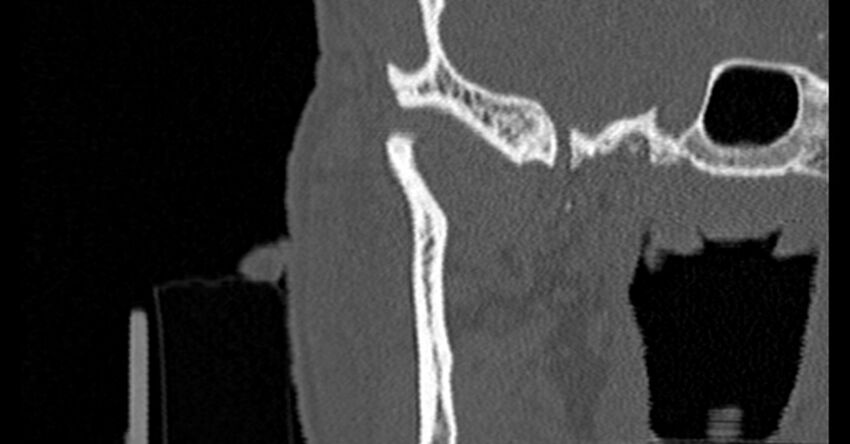 Bilateral temporal bone fractures (Radiopaedia 29482-29970 Coronal non-contrast 28).jpg