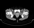 Blind-ending branch of a bifid ureter (Radiopaedia 43613-47034 A 190).jpg