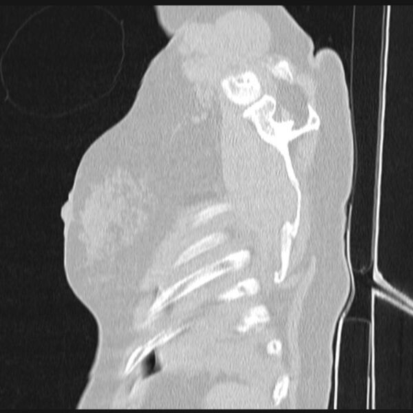File:Boerhaave syndrome (Radiopaedia 45644-49799 Sagittal lung window 82).jpg