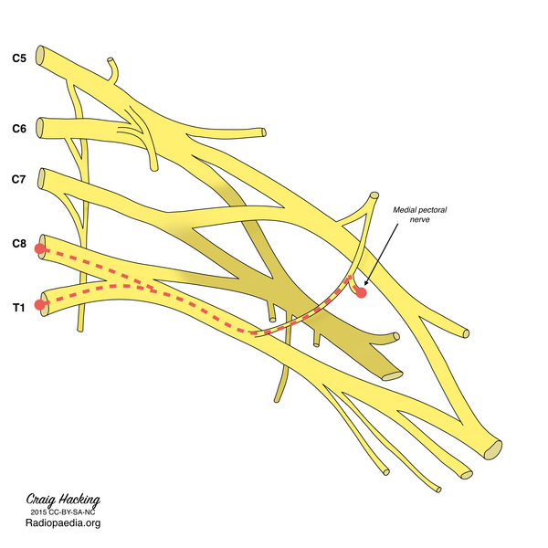 File:Brachial plexus (diagram) (Radiopaedia 37612-39492 L 1).png