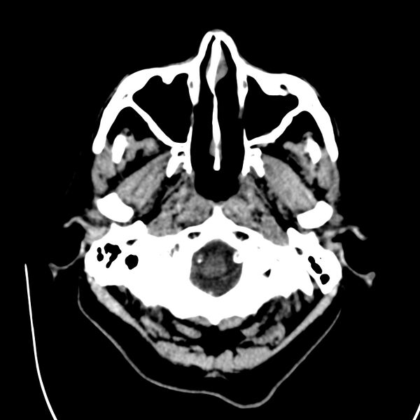 File:Brain Pantopaque remnants (Radiopaedia 78403-91048 Axial non-contrast 18).jpg