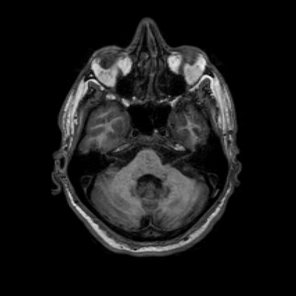 File:Brain abscess complicated by intraventricular rupture and ventriculitis (Radiopaedia 82434-96577 Axial T1 13).jpg