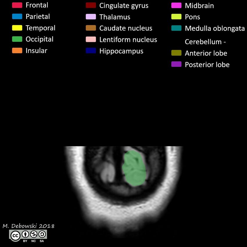 Brain lobes - annotated MRI (Radiopaedia 61691-69700 Coronal 75).JPG