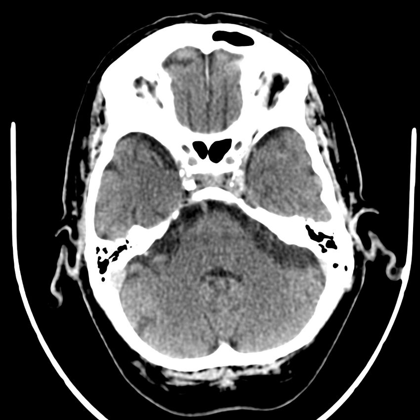 Brain metastasis (Radiopaedia 42617-45760 Axial non-contrast 10).jpg