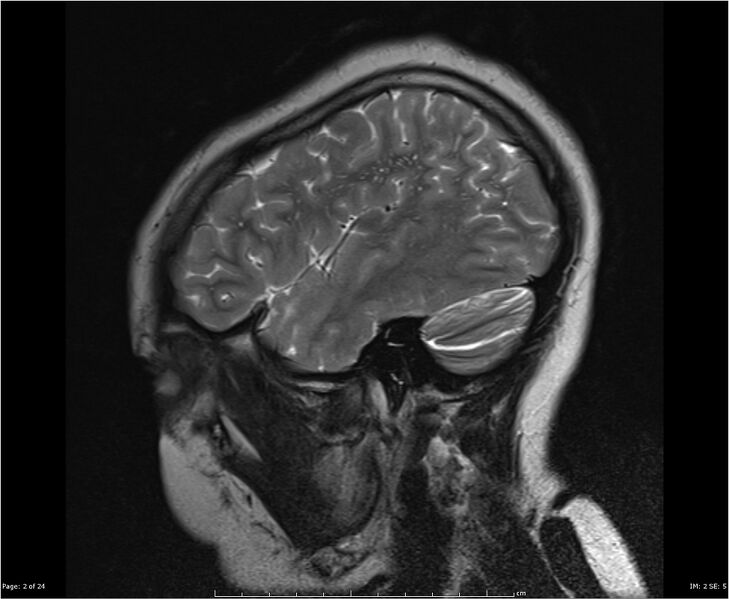 File:Brainstem glioma (Radiopaedia 21819-21775 Sagittal T2 2).jpg