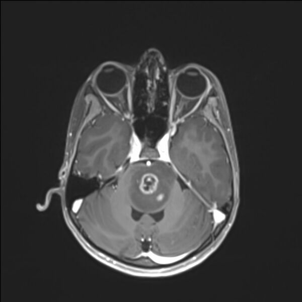 File:Brainstem glioma (Radiopaedia 70548-80674 Axial T1 C+ 50).jpg