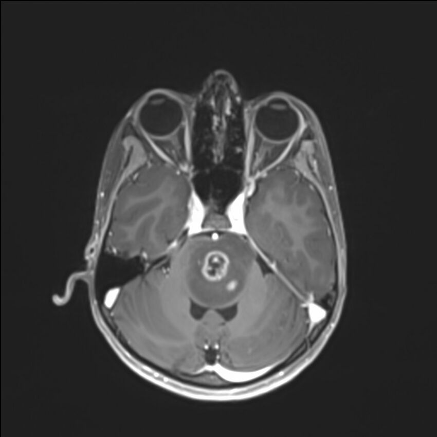 Brainstem glioma (Radiopaedia 70548-80674 Axial T1 C+ 50).jpg