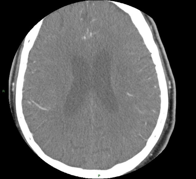 File:Brainstem hemorrhage (Radiopaedia 58794-66028 D 124).jpg