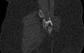 Breast carcinoma with pathological hip fracture (Radiopaedia 60314-67993 Coronal bone window 93).jpg