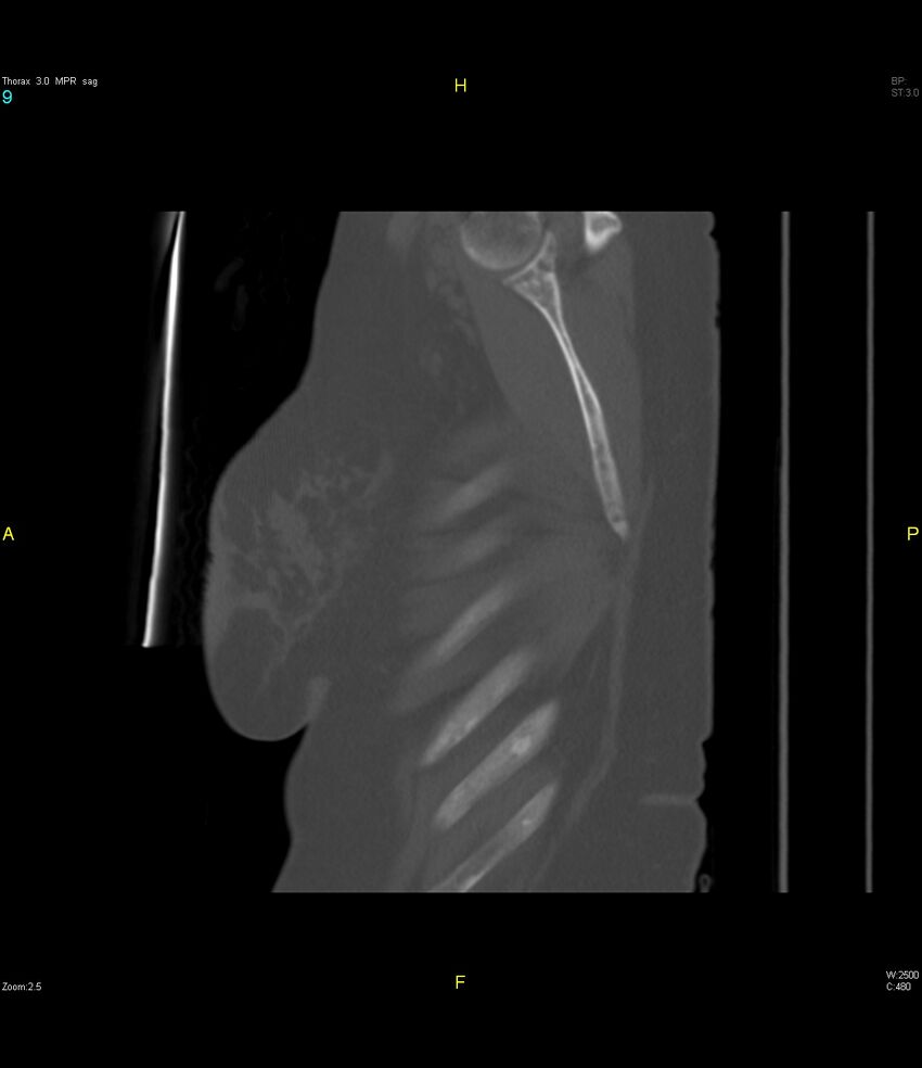 Breast primary with lung and bone metastases (Radiopaedia 40620-43228 Sagittal bone window 9).jpg