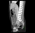 Broad ligament hernia (Radiopaedia 63260-71832 C 24).jpg