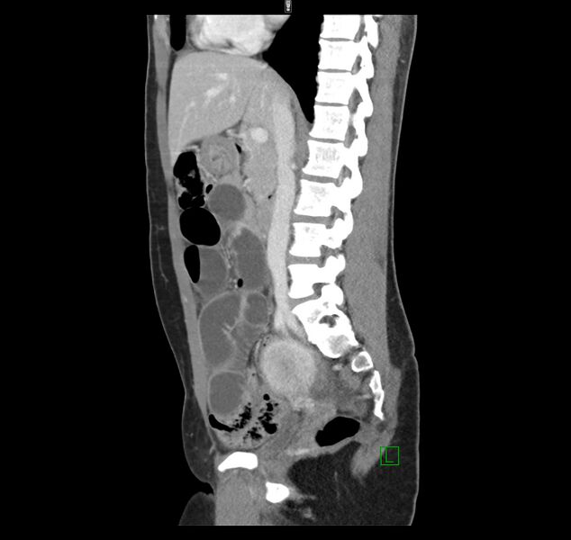 File:Broad ligament hernia (Radiopaedia 63260-71832 C 24).jpg
