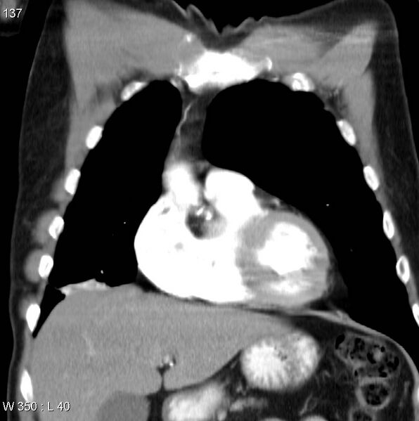 File:Bronchial carcinoid tumor with right lower lobe collapse (Radiopaedia 29060-29422 C 6).jpg