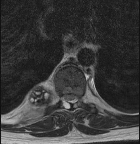 File:Brown tumors compressing the spinal cord (Radiopaedia 68442-78030 A 21).jpg