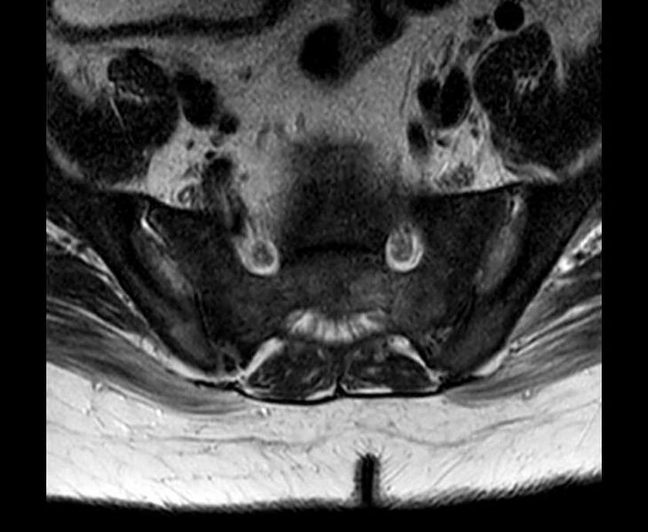 File:Brown tumors compressing the spinal cord (Radiopaedia 68442-78030 Axial T2 - lumbar 9).jpg