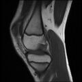 Bucket handle tear - lateral meniscus (Radiopaedia 72124-82634 Sagittal T1 11).jpg