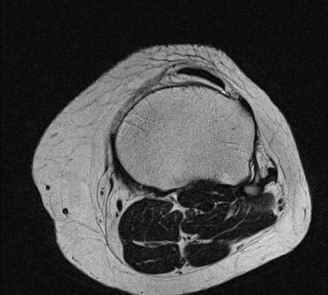 File:Bucket handle tear - medial meniscus (Radiopaedia 79028-91942 Axial T2 5).jpg