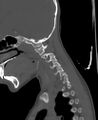 Butterfly vertebra (Radiopaedia 77903-90209 Sagittal bone window 9).jpg