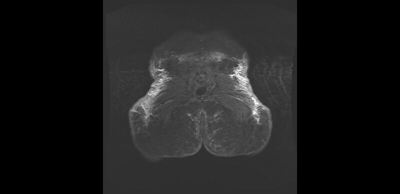 File:Buttock filler complications (Radiopaedia 63497-72115 Coronal STIR 24).jpg