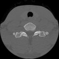 C5 facet fracture (Radiopaedia 58374-65499 Axial bone window 75).jpg