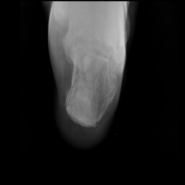 File:Calcaneal fracture (Radiopaedia 22564-22589 Axial 1).JPEG