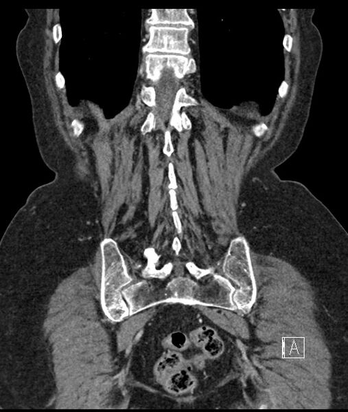 File:Calcified adrenal glands and Spigelian hernia (Radiopaedia 49741-54988 B 97).jpg