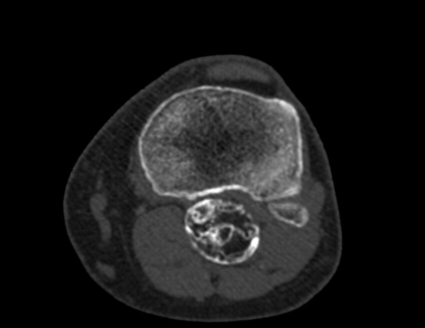 Calcified hematoma - popliteal fossa (Radiopaedia 63938-72763 Axial bone window 55).jpg