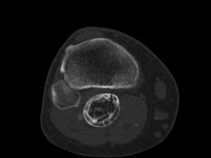 File:Calcified hematoma - popliteal fossa (Radiopaedia 63938-72763 C 64).jpg