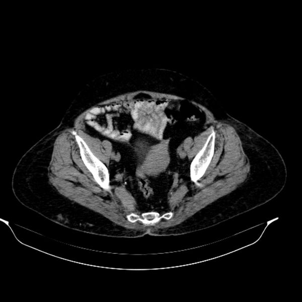 File:Calcified hydatid cyst (Radiopaedia 62000-70085 Axial non-contrast 92).jpg