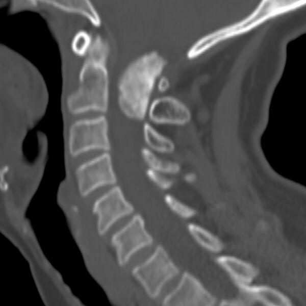 File:Calcified meningioma - cervical canal (Radiopaedia 70136-80171 Sagittal bone window 19).jpg