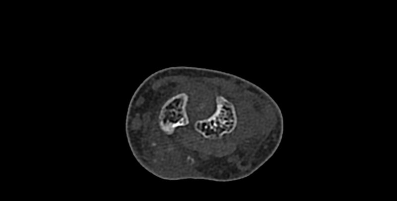 File:Calcifying aponeurotic fibroma (Radiopaedia 88423-105064 Axial bone window 59).jpg