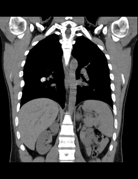 File:Calcifying pulmonary metastases (Radiopaedia 33359-34396 Coronal non-contrast 19).jpg