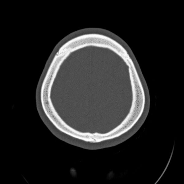 File:Calvarial osteoma (Radiopaedia 36520-38079 Axial bone window 91).jpg
