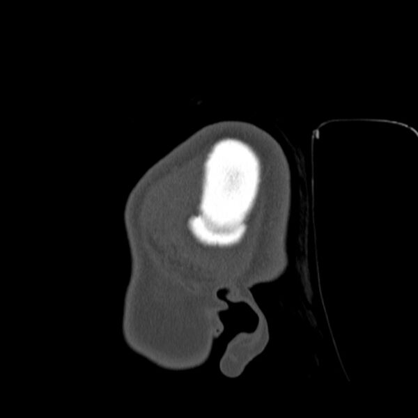 File:Calvarial osteoma (Radiopaedia 36520-38079 Sagittal bone window 104).jpg