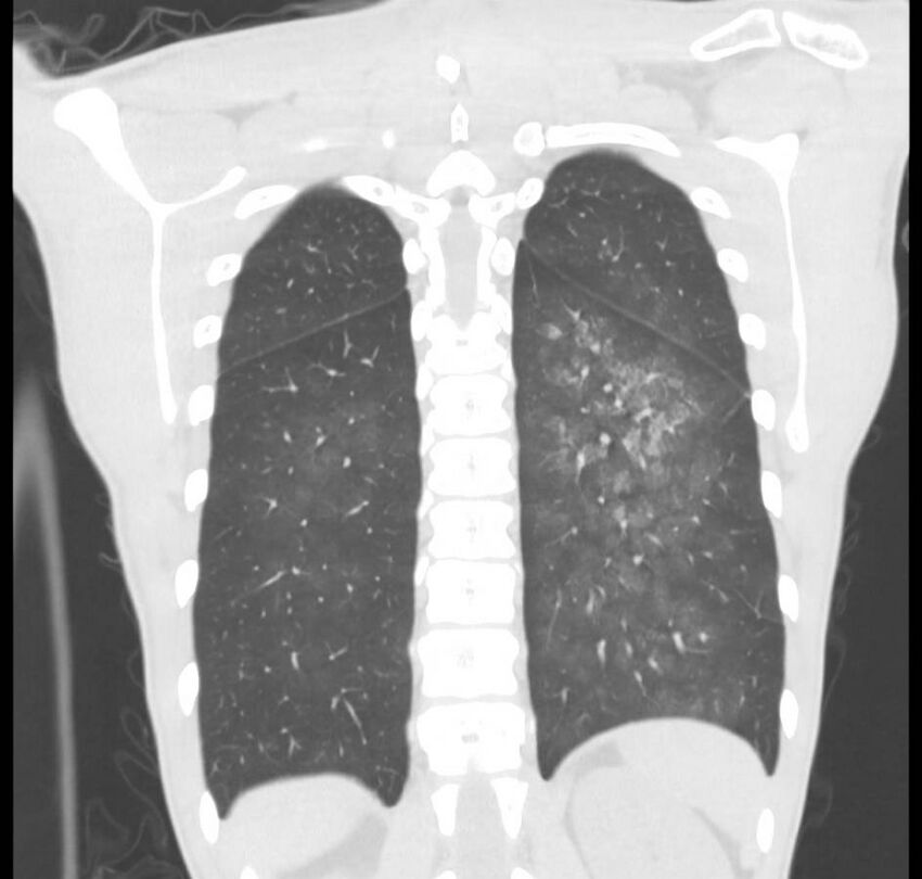 Cannabis-induced diffuse alveolar hemorrhage (Radiopaedia 89834-106946 Coronal lung window 19).jpg