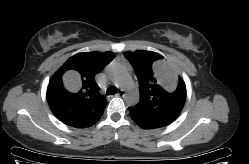 File:Cannonball metastases - uterine choriocarcinoma (Radiopaedia 70137-80173 Axial non-contrast 29).jpg