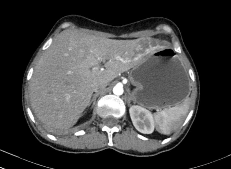 File:Cannonball metastases from breast cancer (Radiopaedia 91024-108569 A 117).jpg