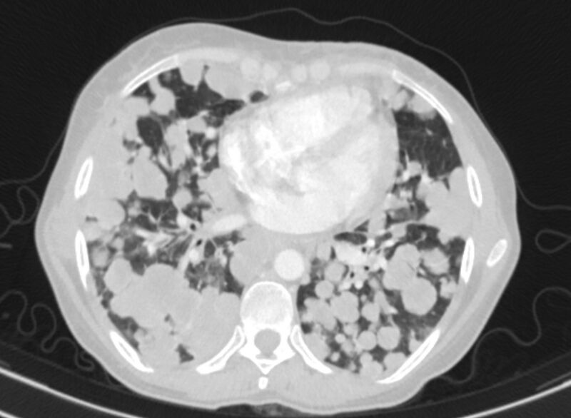 File:Cannonball metastases from breast cancer (Radiopaedia 91024-108569 Axial lung window 62).jpg