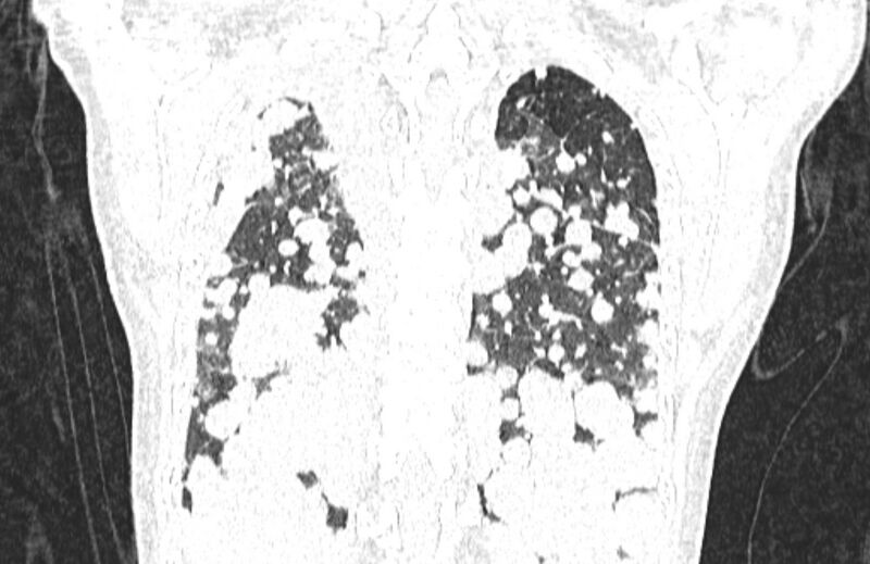 File:Cannonball metastases from breast cancer (Radiopaedia 91024-108569 Coronal lung window 118).jpg