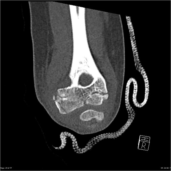 File:Capitellum fracture (Radiopaedia 23352-23426 Coronal bone window 25).jpg