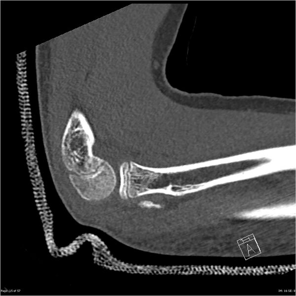 File:Capitellum fracture (Radiopaedia 23352-23426 Sagittal bone window 15).jpg