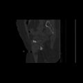Carcinoma cervix- brachytherapy applicator (Radiopaedia 33135-34173 Sagittal bone window 53).jpg