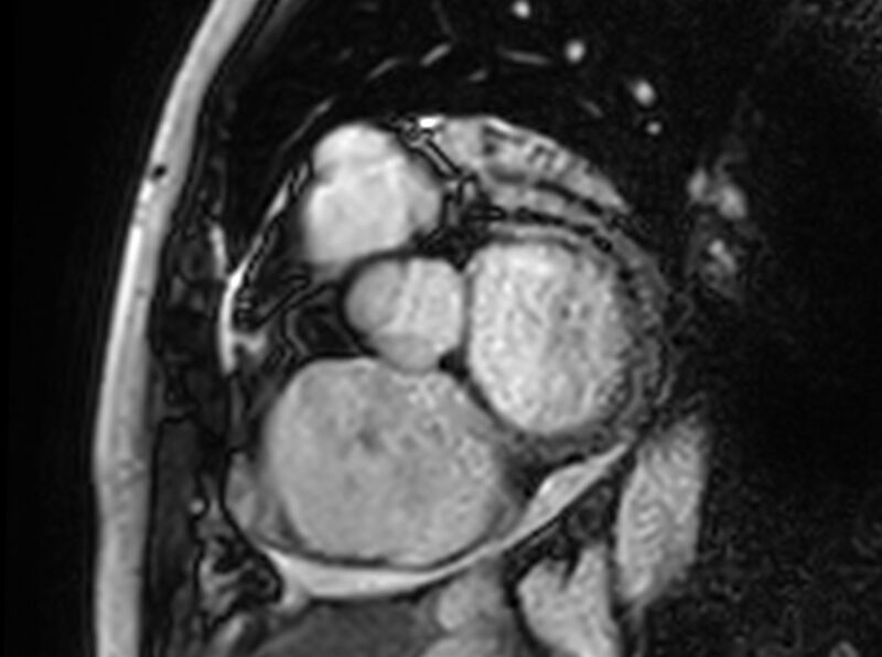 File:Cardiac amyloidosis (Radiopaedia 61600-69579 Short axis bSSFP 311).jpg