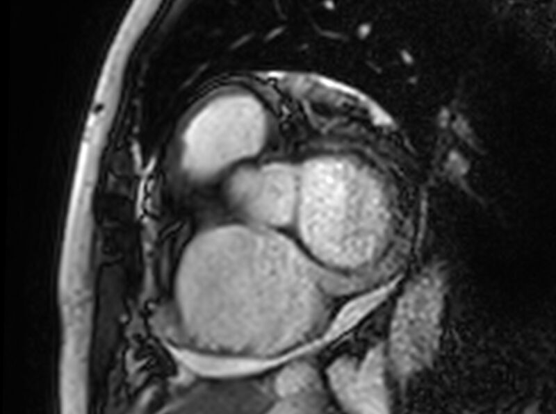 File:Cardiac amyloidosis (Radiopaedia 61600-69579 Short axis bSSFP 327).jpg