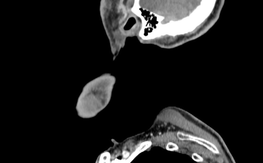 Carotid artery pseudoaneurysm (Radiopaedia 84030-99259 E 66).jpg