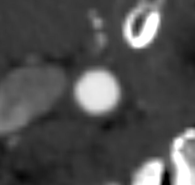 File:Carotid near-occlusion (Radiopaedia 85304-100887 M 21).jpg