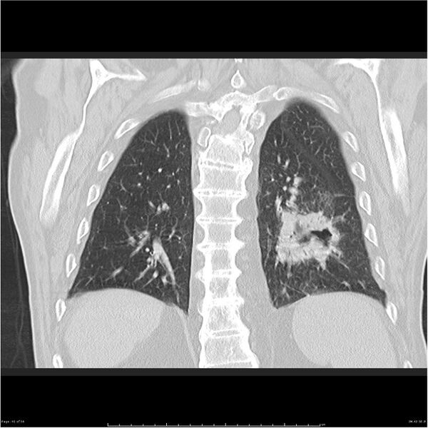 File:Cavitating left lower lobe lesion - squamous cell lung cancer (Radiopaedia 27749-28176 Coronal lung window 41).jpg