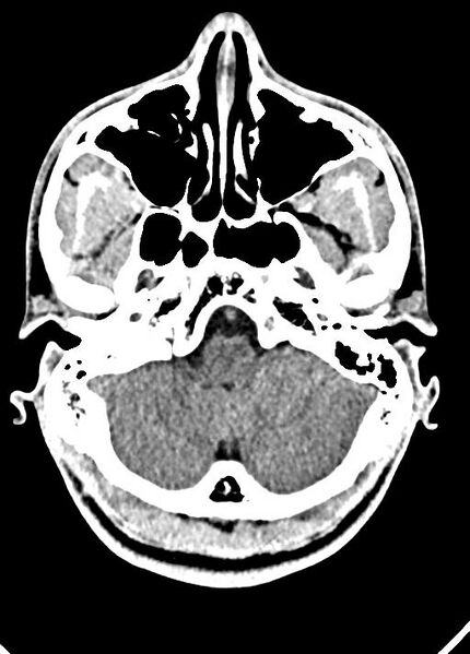 File:Cavum septum pellucidum and cavum vergae (Radiopaedia 77797-90060 Axial Brain Window 19).jpg