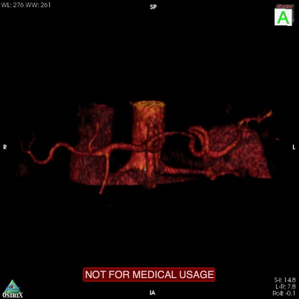 File:Celiac trunk variant anatomy - gastrohepatic trunk and splenic artery (Radiopaedia 38815-40995 B 10).jpg