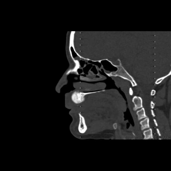 File:Cemento-ossifying fibroma (Radiopaedia 21243-21149 Sagittal bone window 5).jpg